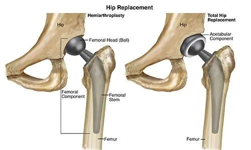 Computer Navigated Partial Knee Replacement India