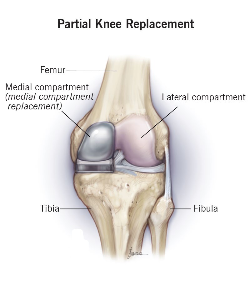 Best Hip Replacement Doctor in Jaipur, India